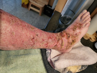 Nach etwa zwei Wochen Behandlung war der Peak erreicht