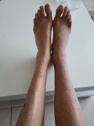 Schönes Ergebnis. Die Haut ist zwar noch nicht weich und geschmeidig, deshalb weiter Behandlung und Einreiben mit Arganöl