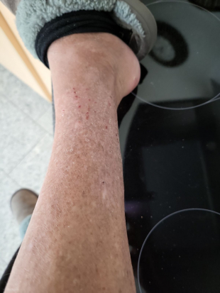 Die Haut ist zwar vernarbt, jedoch schön geschmeidig, weich und absolut schmerzfrei